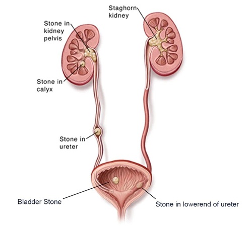 URINARY STONES
