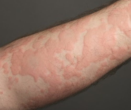 URTICARIA(HIVES)